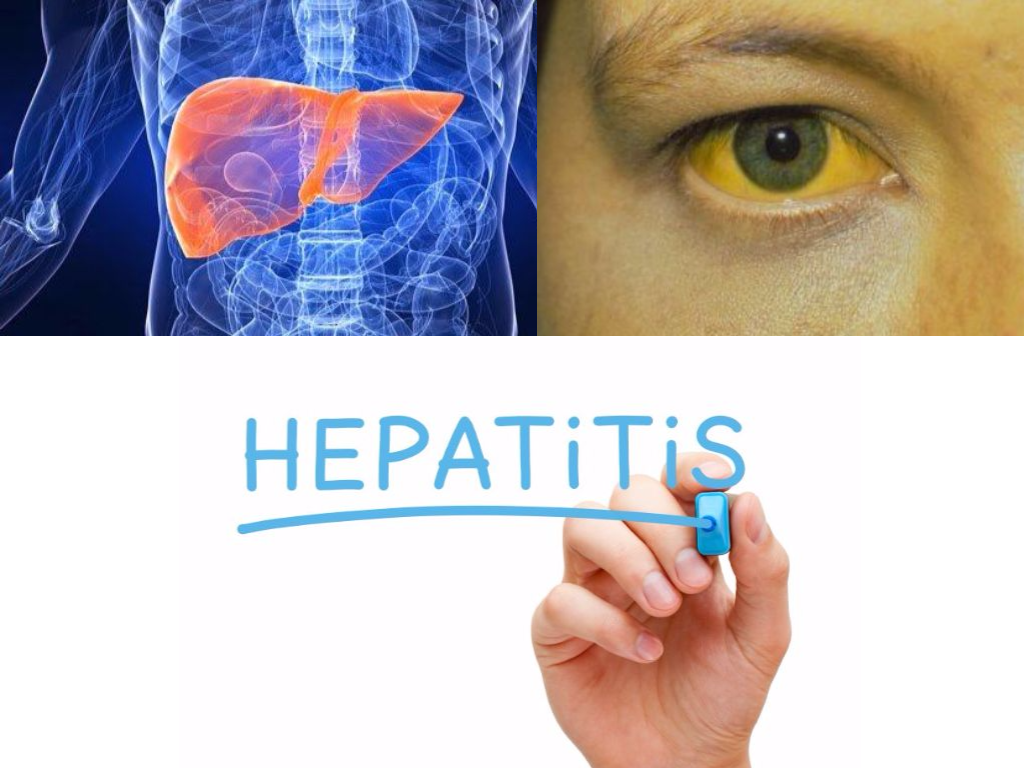 gejala hepatitis