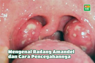 radang-amandel