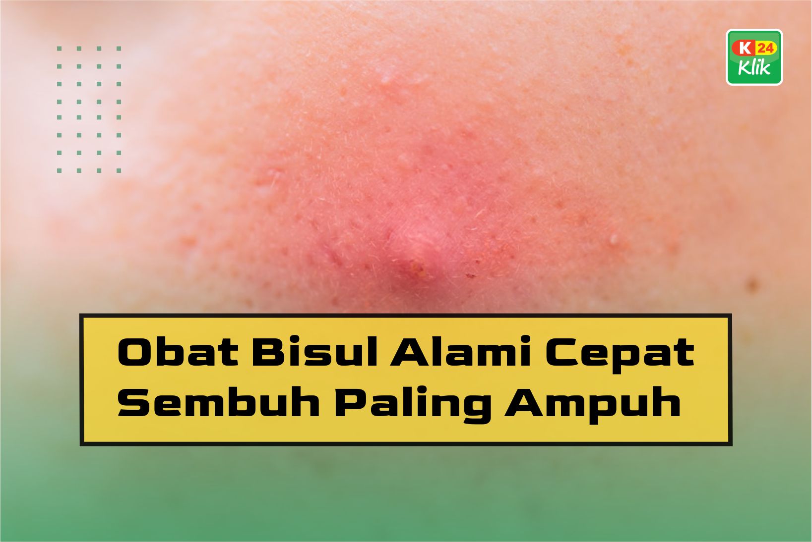 Obat Bisul Alami Cepat Sembuh Paling Ampuh